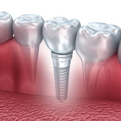 implant_img implant_img